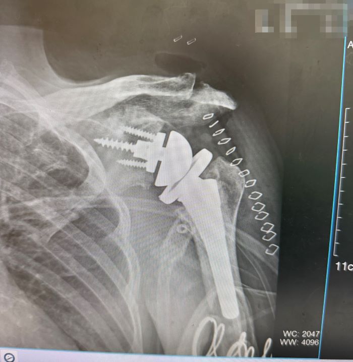 《圖說》反式人工肩關節手術，改善長期肩關節退化合併旋轉肌嚴重破裂。〈臺北醫院提供〉